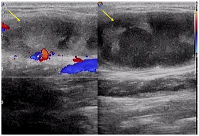 Isolated soft tissue tuberculosis: a case report and literature review